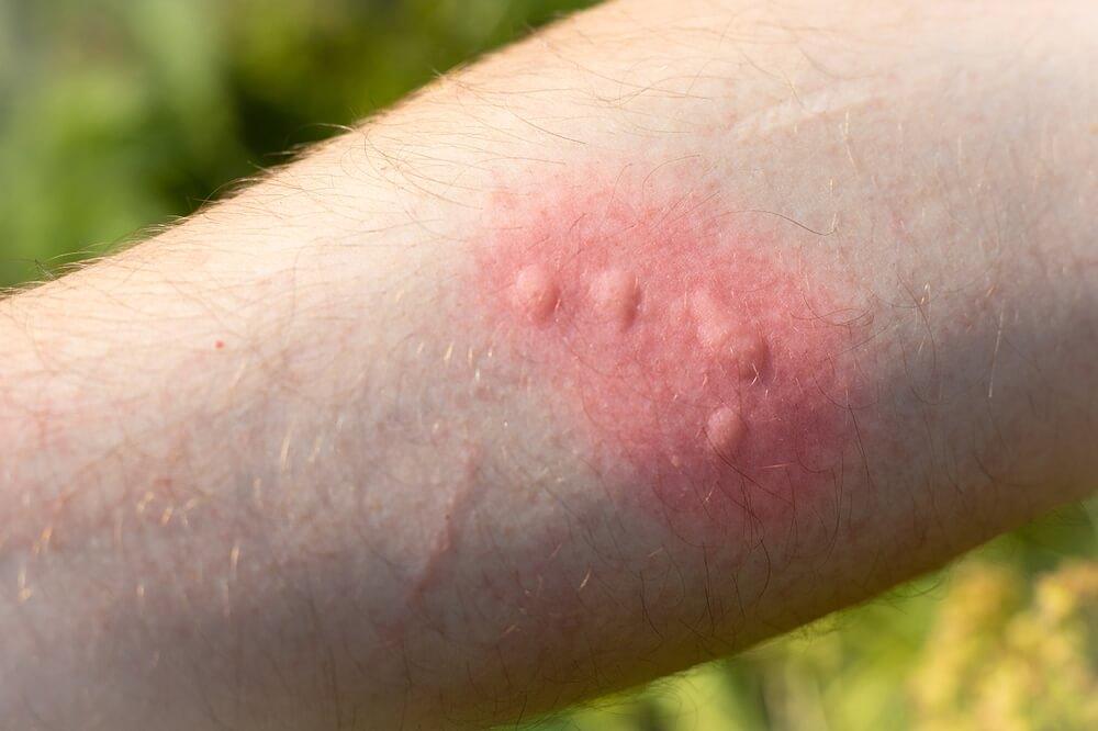 Nettle Rash Children Blog - TrainAid Ltd